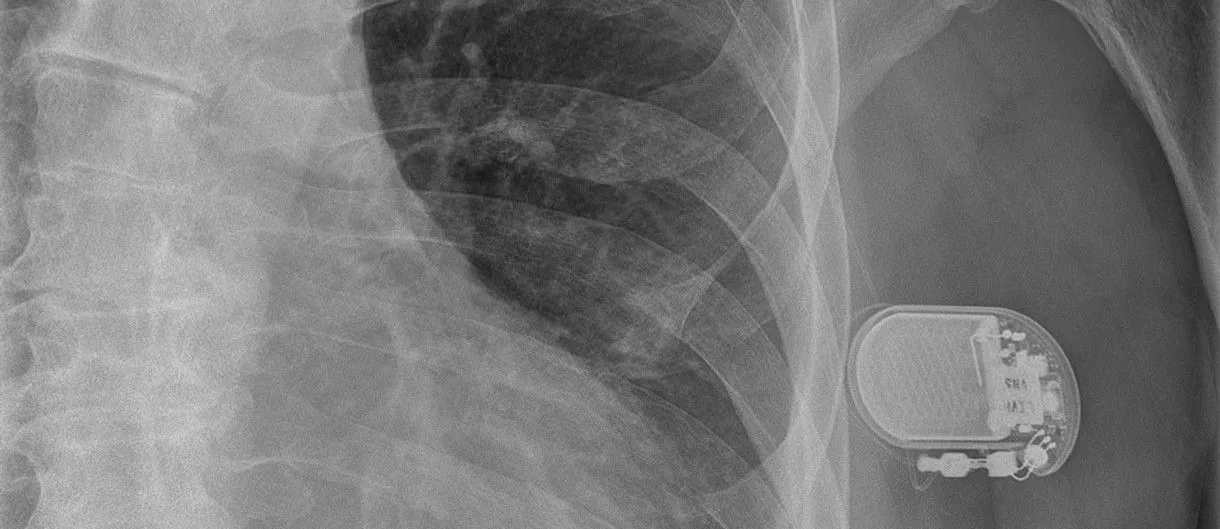 A chest radiograph showing an implanted vagus nerve stimulator, its oval pulse generator and lead connector visible against the ribs below the left collarbone.