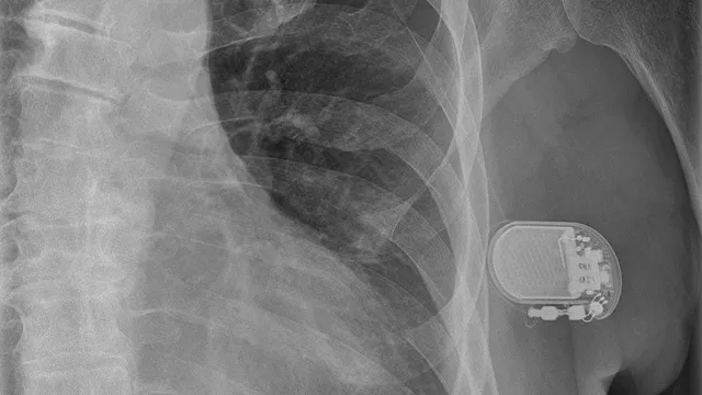 A chest radiograph showing an implanted vagus nerve stimulator, its oval pulse generator and lead connector visible against the ribs below the left collarbone.