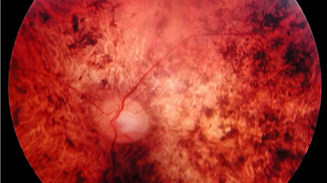 A colour fundus photograph of a human retina, the pale optic disc left of centre with vessels branching from it, and broad mottled patches of pale atrophy and dark pigment spreading across the surrounding retina.