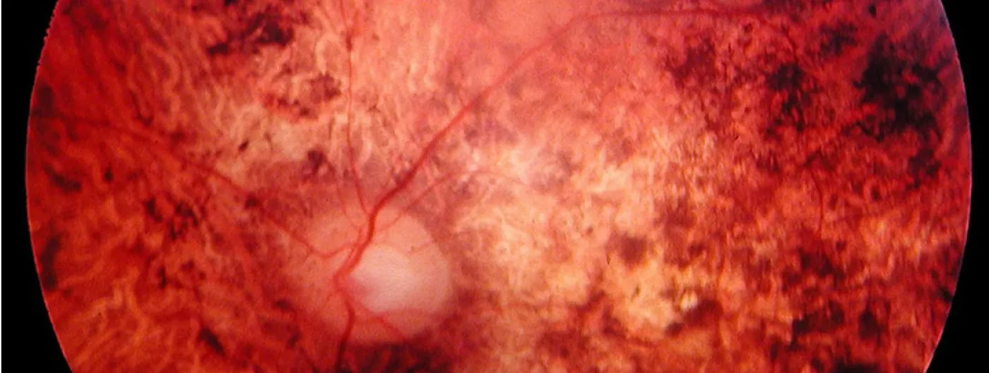A colour fundus photograph of a human retina, the pale optic disc left of centre with vessels branching from it, and broad mottled patches of pale atrophy and dark pigment spreading across the surrounding retina.