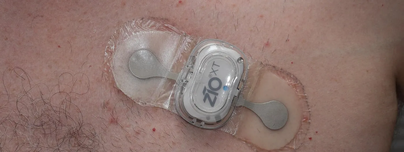An adhesive cardiac monitoring patch stuck to a person's bare chest, its small white recorder body marked ZIO XT, flanked by two oval pads of clear film with metal electrode studs beneath them.