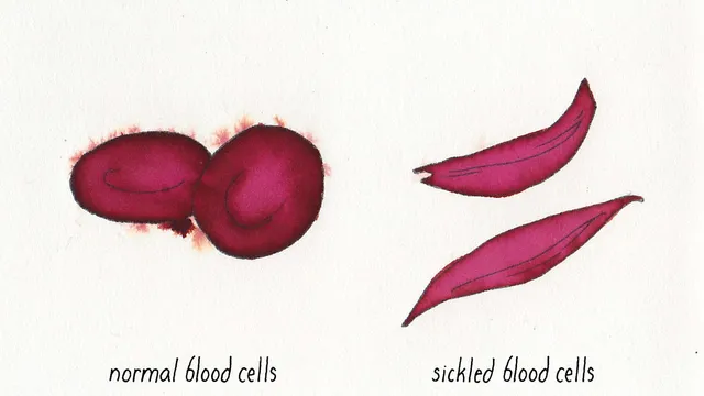 A watercolour illustration comparing red blood cells: two rounded discs labelled normal blood cells on the left, and two long curved crescents labelled sickled blood cells on the right.