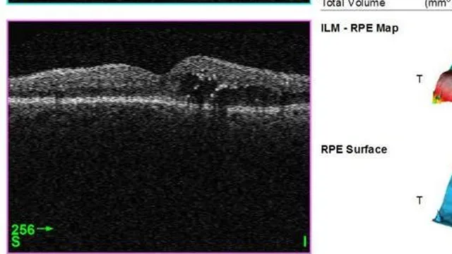 Grayscale optical coherence tomography cross-section of a human retina showing thickened tissue and small cystic fluid pockets characteristic of diabetic macular edema.