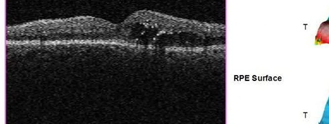 Grayscale optical coherence tomography cross-section of a human retina showing thickened tissue and small cystic fluid pockets characteristic of diabetic macular edema.