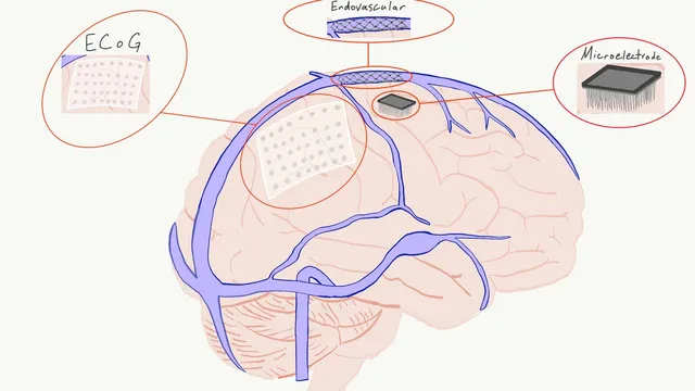 A hand-drawn diagram of a brain with its surface veins, labelled with three inset close-ups of an ECoG grid, an endovascular stent electrode and a penetrating microelectrode array.
