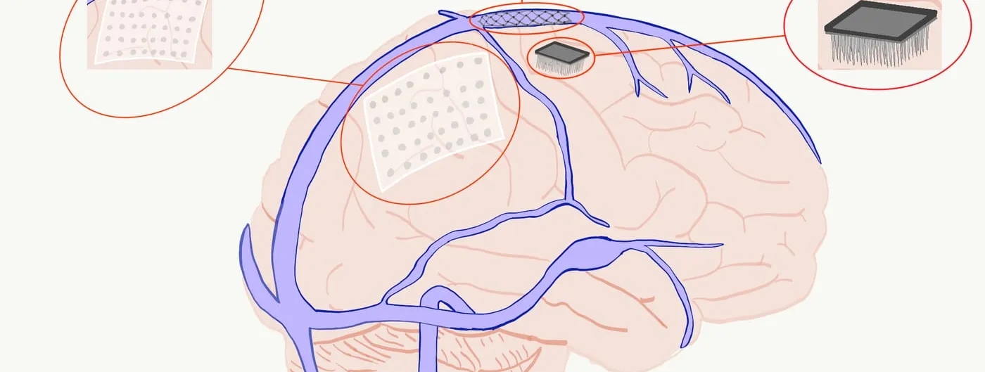A hand-drawn diagram of a brain with its surface veins, labelled with three inset close-ups of an ECoG grid, an endovascular stent electrode and a penetrating microelectrode array.