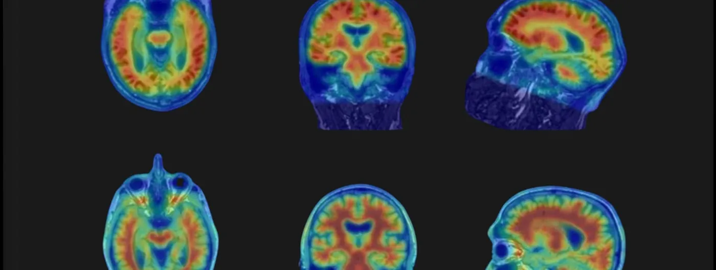 Six false-colour brain scans arranged in two rows on a dark monitor, each showing axial, coronal and sagittal views with red and yellow marking high tracer uptake and blue marking low uptake.