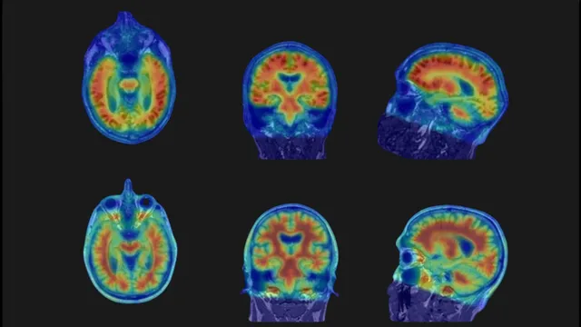 Six false-colour brain scans arranged in two rows on a dark monitor, each showing axial, coronal and sagittal views with red and yellow marking high tracer uptake and blue marking low uptake.