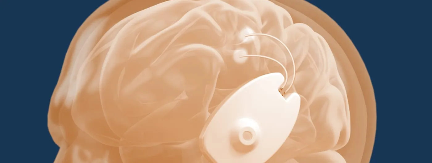 A translucent rendering of a human head and brain shows the white CraniUS Plate implant with two curved lead wires seated against the skull above the ear.