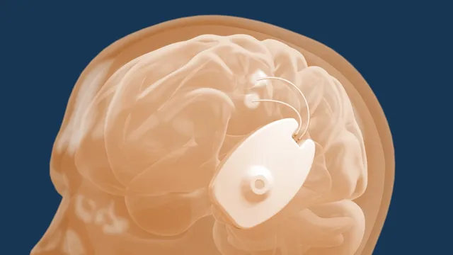 A translucent rendering of a human head and brain shows the white CraniUS Plate implant with two curved lead wires seated against the skull above the ear.
