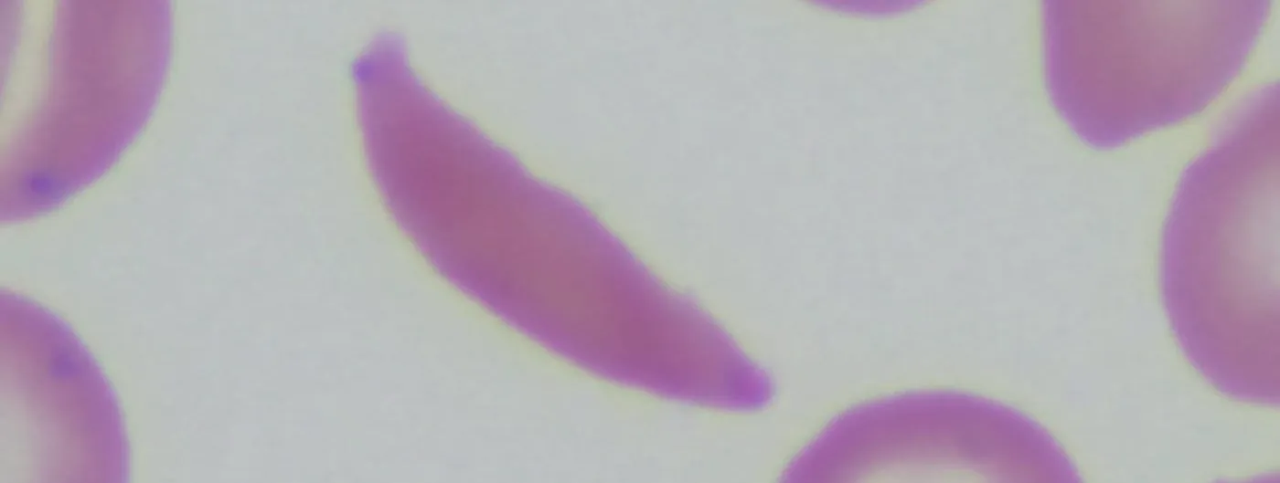A photomicrograph of a blood smear showing rounded normal red blood cells alongside elongated crescent-shaped sickle cells.