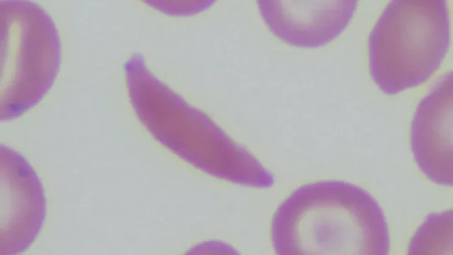 A photomicrograph of a blood smear showing rounded normal red blood cells alongside elongated crescent-shaped sickle cells.