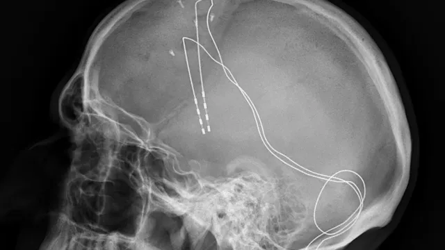 Lateral skull X-ray showing implanted deep-brain-stimulation electrode leads running from contacts in the brain down to a coiled length of excess wire near the ear, illustrating implantable neurostimulator hardware generically rather than the Genlight device itself.
