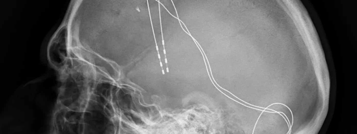 Lateral skull X-ray showing implanted deep-brain-stimulation electrode leads running from contacts in the brain down to a coiled length of excess wire near the ear, illustrating implantable neurostimulator hardware generically rather than the Genlight device itself.