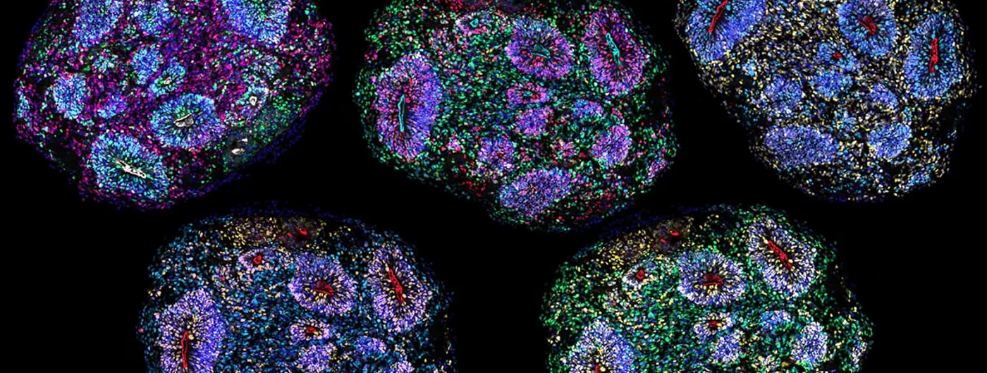 Five fluorescently stained sections of brain organoids on a black background, each a rounded mass a few millimetres across speckled in blue, green, magenta and yellow, with rosette-shaped clusters of densely packed cell nuclei.
