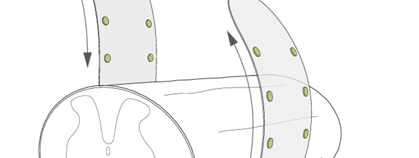 A line diagram of a spinal cord segment shown in cross-section, with a flexible band of round electrodes curving down and around its outer surface like a cuff.