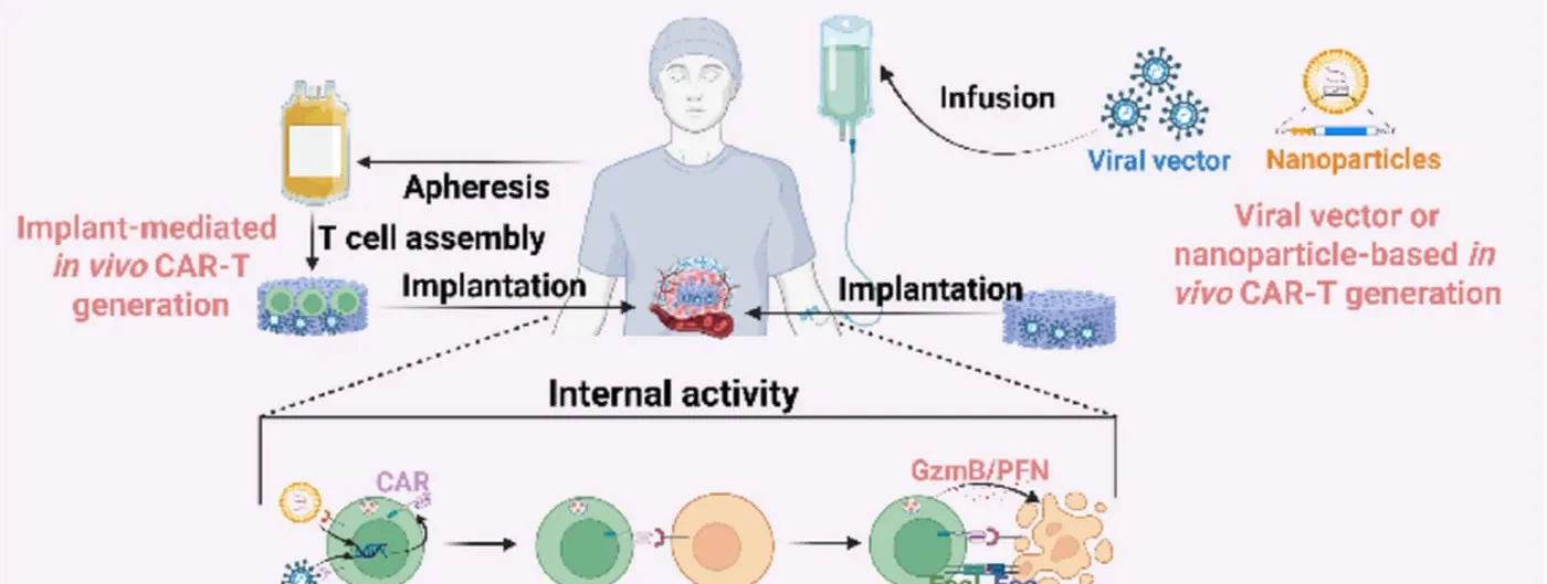 Diagram of in vivo CAR-T therapy showing a patient receiving an intravenous infusion of viral vector or nanoparticles that generate CAR T cells inside the body, with a lower panel illustrating those cells binding to and killing pathogenic cells.