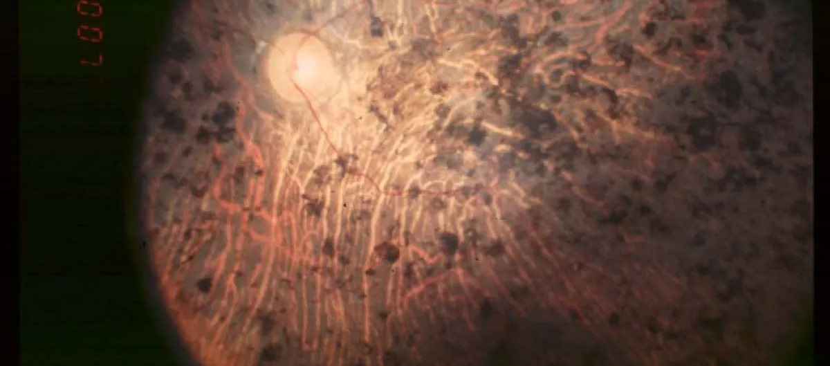 Fundus photograph of an eye with advanced retinitis pigmentosa, showing dark pigment clumps scattered across the retina around a pale optic disc and thinned blood vessels.