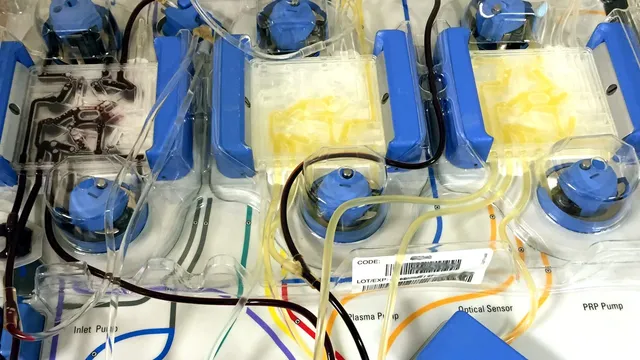 Close-up of an apheresis machine's disposable blood-separation kit, with blue pump heads, clear plastic chambers and colour-coded tubing of the kind used to collect a patient's cells for CAR-T therapy.