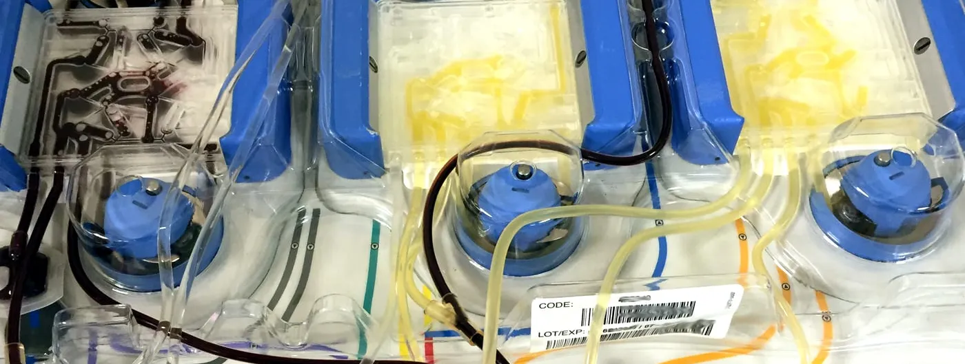 Close-up of an apheresis machine's disposable blood-separation kit, with blue pump heads, clear plastic chambers and colour-coded tubing of the kind used to collect a patient's cells for CAR-T therapy.