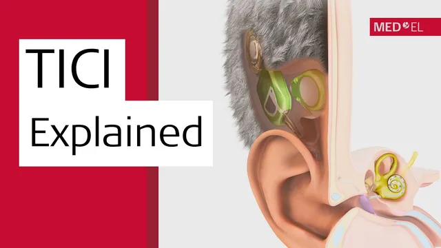 An illustrated cutaway of a human ear on a light grey background, showing a green implant package and a round coil tucked under the skin and hair behind the ear, with an electrode running to a gold cochlea, beside the words TICI Explained on a red panel.