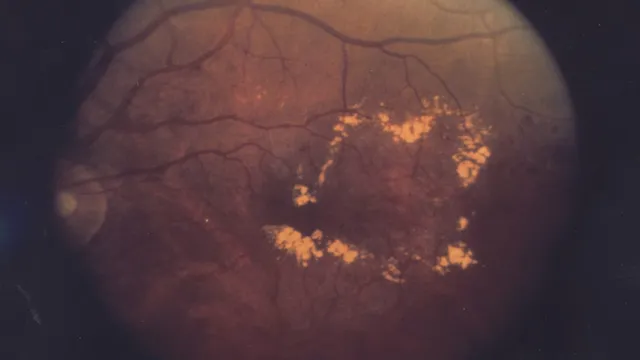 Fundus photograph of a diabetic eye showing a ring of yellow-white hard exudates surrounding the macula, the classic sign of diabetic macular edema.