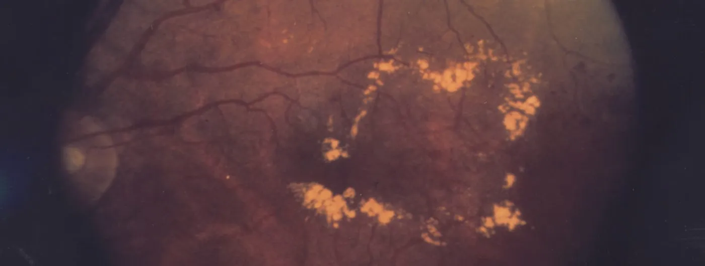 Fundus photograph of a diabetic eye showing a ring of yellow-white hard exudates surrounding the macula, the classic sign of diabetic macular edema.