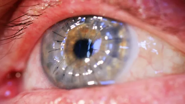 Extreme close-up photograph of a bloodshot human eye after corneal transplant surgery, showing fine black sutures encircling the grafted cornea and bright reflections of overhead surgical lighting on its surface.