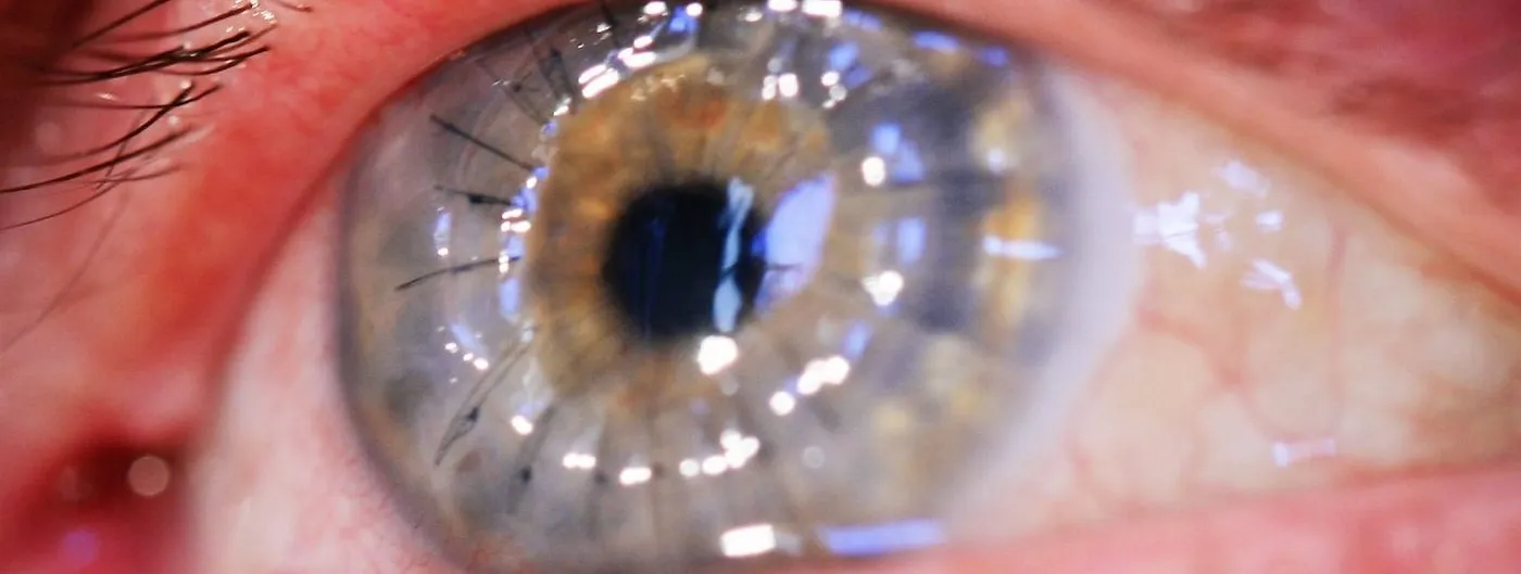 Extreme close-up photograph of a bloodshot human eye after corneal transplant surgery, showing fine black sutures encircling the grafted cornea and bright reflections of overhead surgical lighting on its surface.