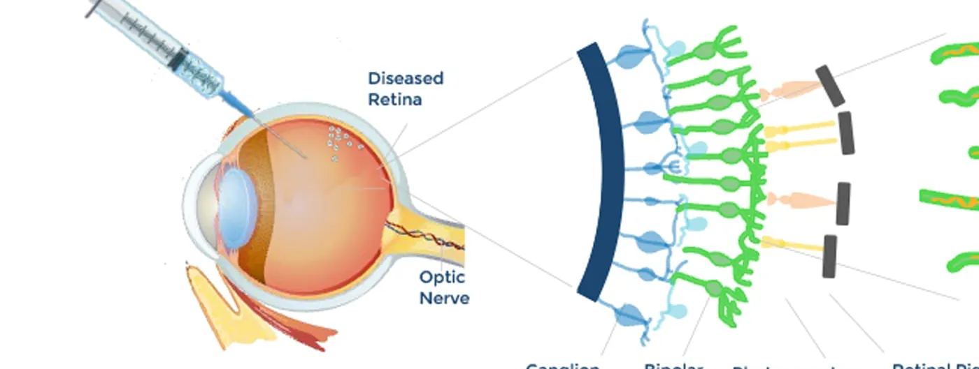 Nanoscope Therapeutics diagram of an intravitreal injection into a diseased retina, beside a schematic of ganglion cells, bipolar cells and degenerating photoreceptors.
