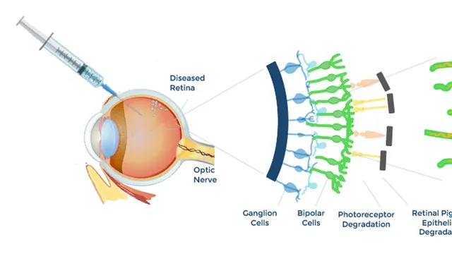 Nanoscope Therapeutics diagram of an intravitreal injection into a diseased retina, beside a schematic of ganglion cells, bipolar cells and degenerating photoreceptors.