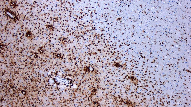 An immunostained section of brain tissue under the microscope, where dense brown-stained immune cells crowd the left of the frame and thin out across a paler region to the right.