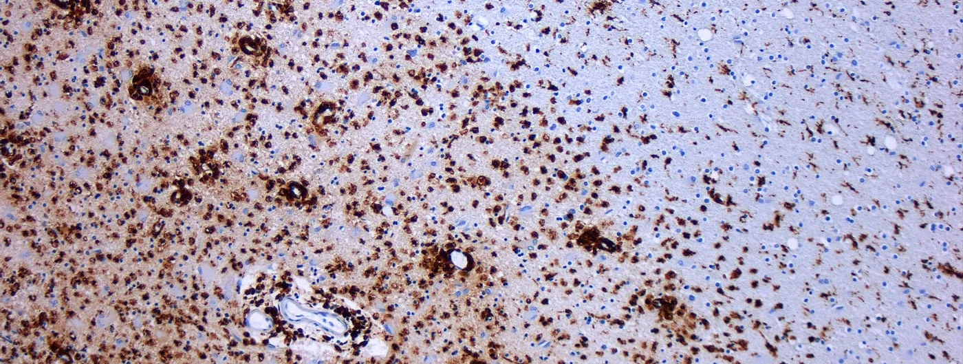 An immunostained section of brain tissue under the microscope, where dense brown-stained immune cells crowd the left of the frame and thin out across a paler region to the right.