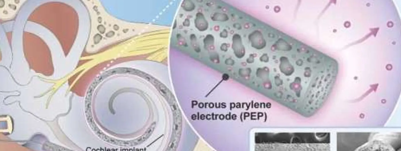 A diagram of a coiled cochlear implant electrode inside the cochlea sits beside a cutaway showing the porous electrode releasing drug particles, with electron microscope cross-sections of the electrode alongside.