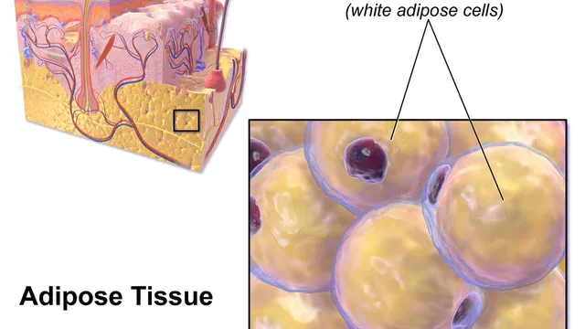 A medical illustration of adipose tissue: a cutaway block of skin with a yellow layer of fat beneath it, beside a magnified panel of rounded white adipose cells packed together.