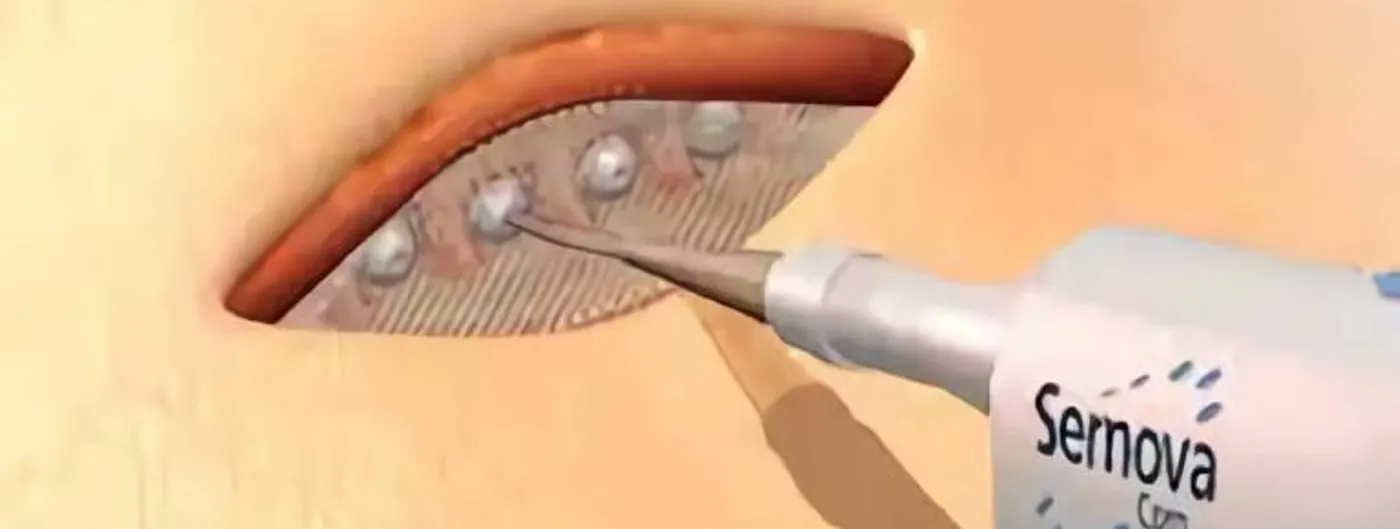 A rendering shows Sernova's flexible mesh Cell Pouch device being slid beneath the skin of the abdomen using a surgical applicator branded Sernova.