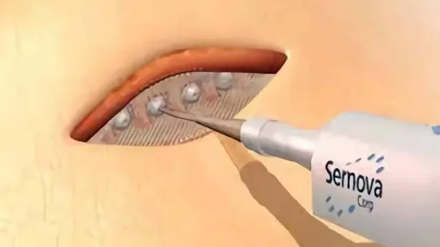 A rendering shows Sernova's flexible mesh Cell Pouch device being slid beneath the skin of the abdomen using a surgical applicator branded Sernova.
