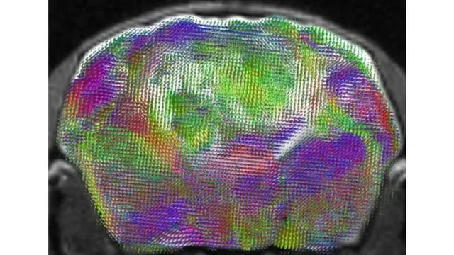Cross-sectional MRI of a mouse brain overlaid with a colour-coded map of nerve-fibre pathways running through the transplanted human cortical tissue.