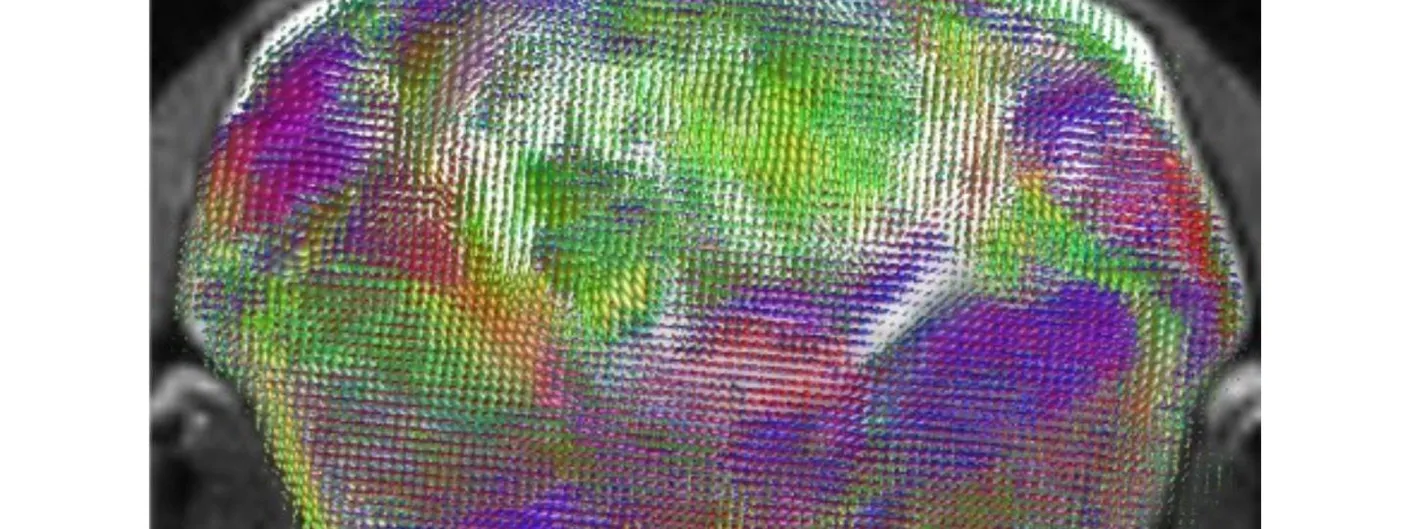 Cross-sectional MRI of a mouse brain overlaid with a colour-coded map of nerve-fibre pathways running through the transplanted human cortical tissue.