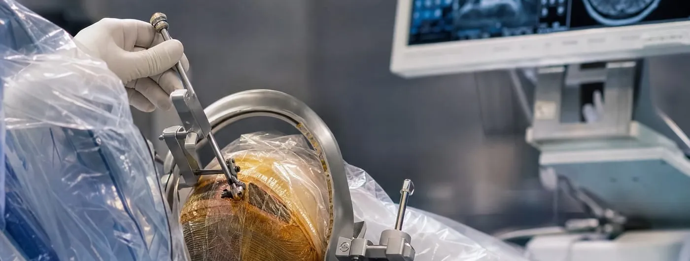 A gloved hand guides a slender surgical instrument on a stereotactic frame clamped around a draped human head in an operating room, with brain MRI scans on a monitor behind.