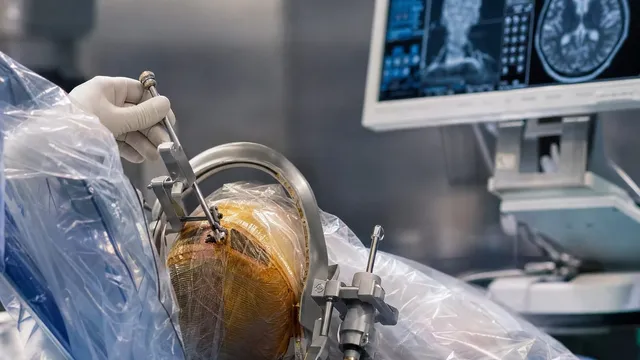 A gloved hand guides a slender surgical instrument on a stereotactic frame clamped around a draped human head in an operating room, with brain MRI scans on a monitor behind.