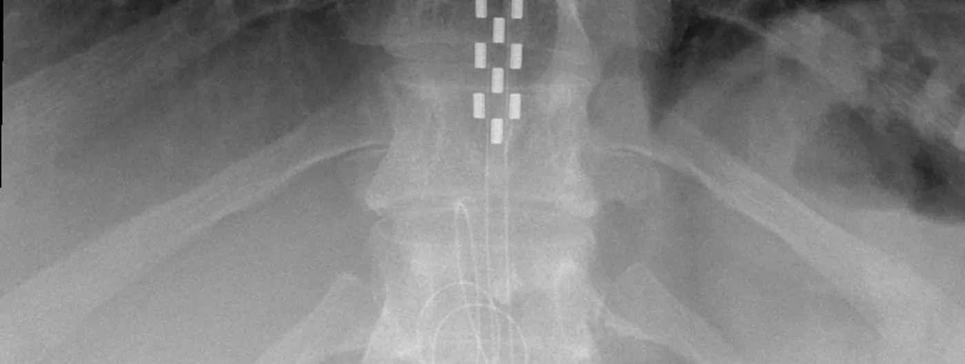 Anterior X-ray of a spine showing an implanted spinal cord stimulator paddle lead, its rows of bright rectangular electrode contacts running down the epidural space, with a second percutaneous lead and its coiled wire lower in the frame. A generic clinical case, not the hardware used in this trial.