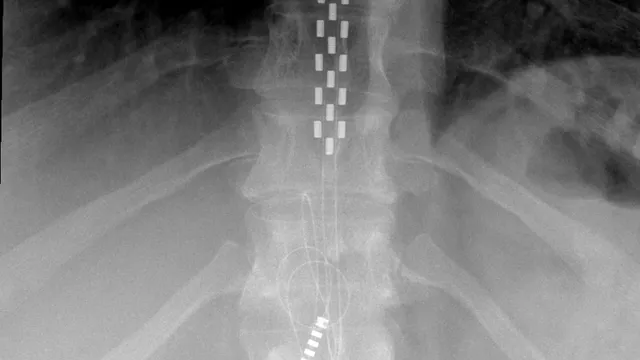 Anterior X-ray of a spine showing an implanted spinal cord stimulator paddle lead, its rows of bright rectangular electrode contacts running down the epidural space, with a second percutaneous lead and its coiled wire lower in the frame. A generic clinical case, not the hardware used in this trial.