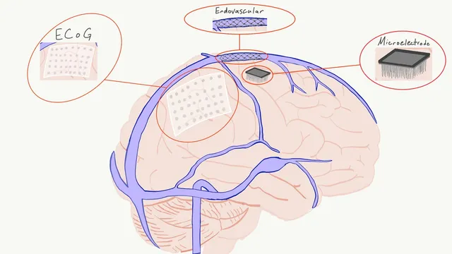 A hand-drawn anatomical illustration of a brain with its surface vessels, labelled with three implant types: an ECoG electrode grid, an endovascular stent electrode, and a bed-of-nails microelectrode array.