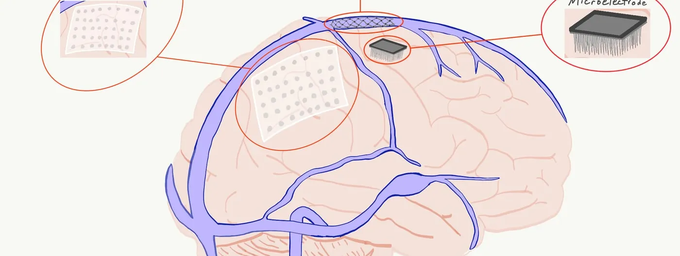A hand-drawn anatomical illustration of a brain with its surface vessels, labelled with three implant types: an ECoG electrode grid, an endovascular stent electrode, and a bed-of-nails microelectrode array.