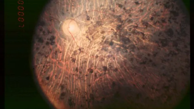 A fundus photograph of an eye with end-stage retinitis pigmentosa, showing dark clumps of pigment scattered across the retina, thinned orange vessels and a pale optic disc.